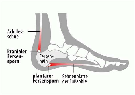 Fersensporn Wadenschmerzen Fersensporn Fersensporn Hausmittel