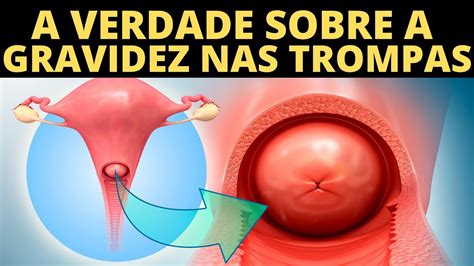 Gravidez Nas Trompas Quais Os Sintomas YouTube