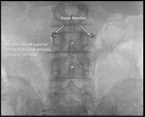 Fluoroscopic Anterior Posterior View Showing Initial Placement Of Guide