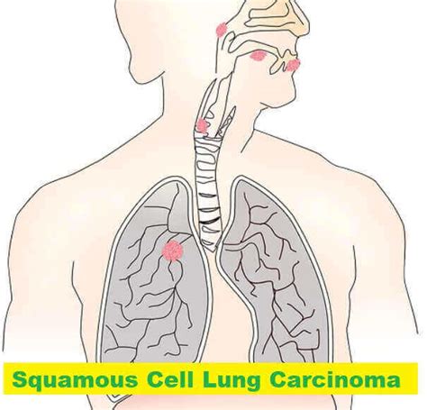 Squamous Cell Lung Carcinoma: 10 Causes, Symptoms, And Diagnosis And ...