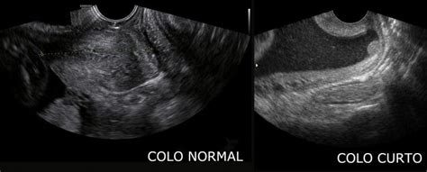 O Que A Medida Do Colo Uterino Na Gravidez Fetalmed Medicina Fetal