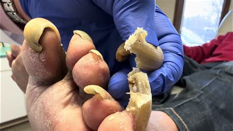 Unbelievable Toenails So Long And Painful That Patient Cannot Walk Youtube