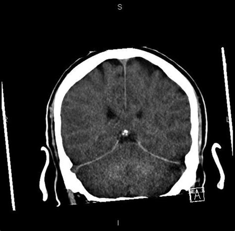 The Reversal Sign Bmj Case Reports