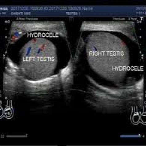 Testicularscrotum Ultrasound Test 1s Pharma Xonline