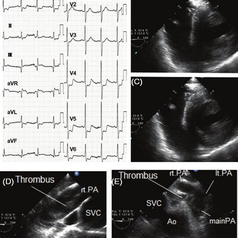 A Chest X Ray An Electrocardiogram And A Transthoracic Echocardiogram