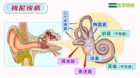 成都民生耳鼻喉医院：梅尼埃综合征的典型症状你中了几招？国家三级专科医院凤凰网湖南 凤凰网