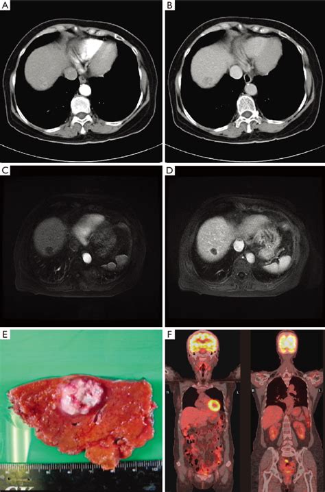 Radiologic And Gross Appearance Of The PHNET A Contrast Enhanced CT