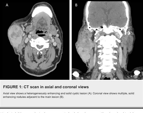 Figure 1 From A Case Of A Coexisting Carcinosarcoma Ex Pleomorphic Adenoma With Langerhans Cell