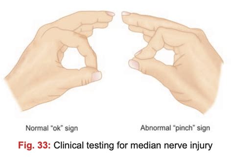 Clinical testing for median nerve injury : r/notesmedical