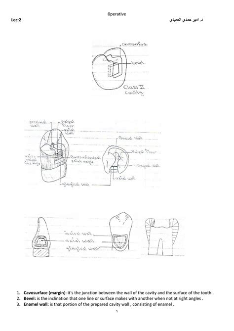 0perative Cavosurface (margin Bevel: