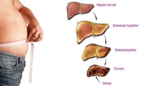 Esteatosis Hepática No Alcohólica Tvo Mexico