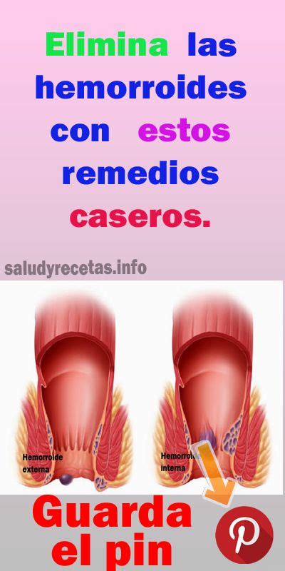 Elimina Las Hemorroides Con Estos Remedios Caseros Remedios Caseros