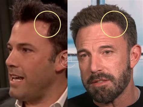 Ben Affleck Hair Transplant Hair Loss And Technical Analysis