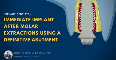 How To Perform Immediate Implants After Molar Extraction Using A