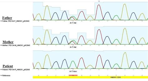 Chromatograms Of Sanger Sequencing Of HMOX1 Whole Exome Sequencing