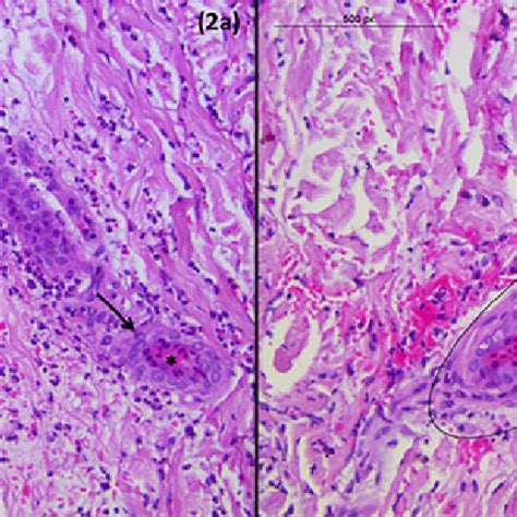 A High Power View Of Neutrophilic Infiltration Of Eccrine Sweat