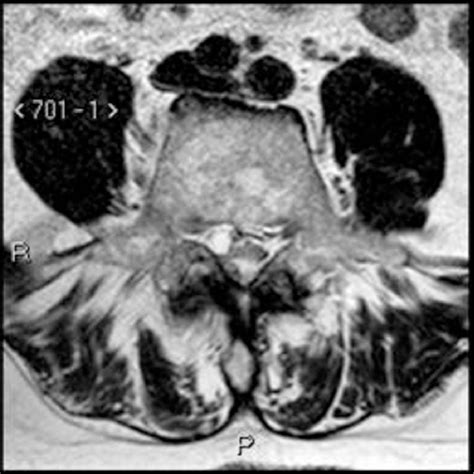 Figure 1 From Ct Guided Treatment Of Spinal Synovial Cysts Semantic Scholar