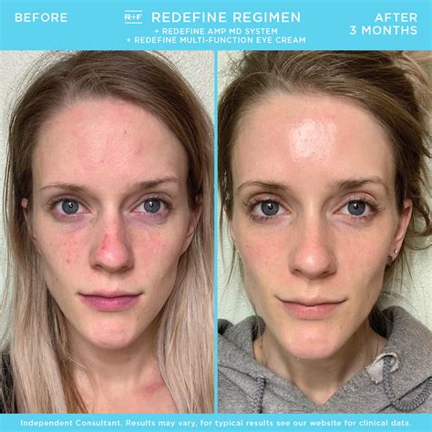 20 Rodan and Fields Before and After Pictures That Will Shock You - The ...