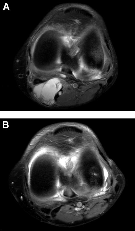 Arthroscopic Treatment Of Popliteal Cysts Clinical And Magnetic