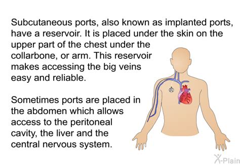 Patedu Port Catheter Insertions