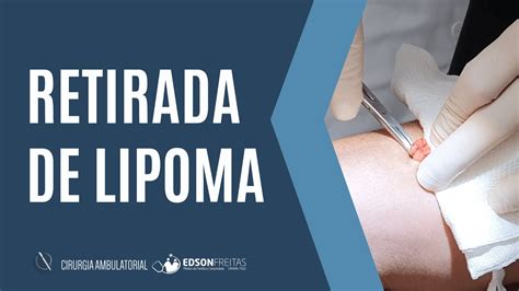 Retirada De LIPOMA Pequeno YouTube