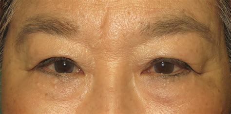 Lower Blepharoplasty Aina Haina Eye Center