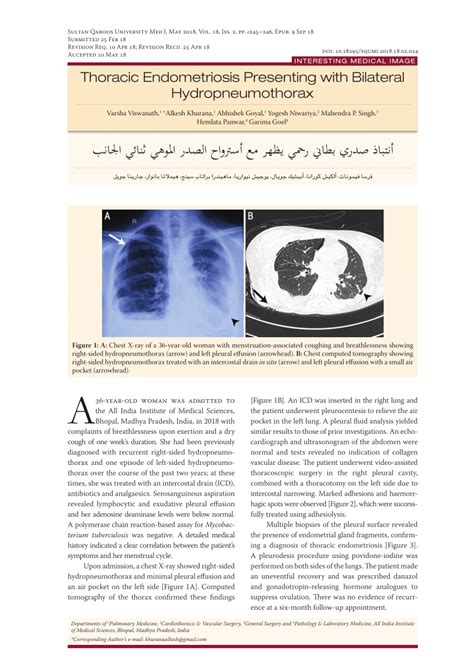 PDF ا Thoracic Endometriosis Presenting with Bilateral Hydropneumothorax