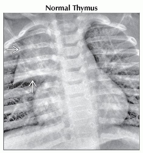 Mediastinal Widening Obgyn Key