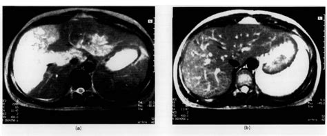 Figure 1 From Hepatic Necrosis And Haemorrhage In Pregnant Patients