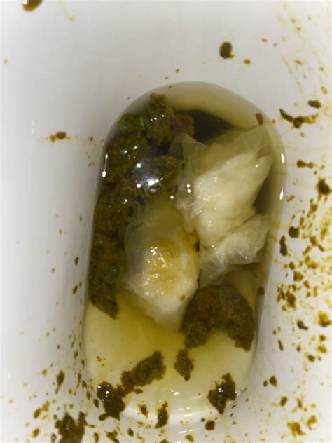 Please help. Could this be a sign of upper gastrointestinal bleeding