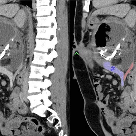 Sagittal Section Of Pre Operative Ct With Portal Venous Contrast Download Scientific Diagram