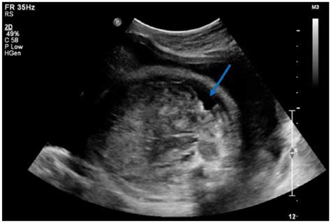 Prenatal Sonographic Detection Of Ebsteins Anomaly Mariah C Root