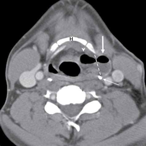 Cystic Lesions Of The Head And Neck Radiology Key