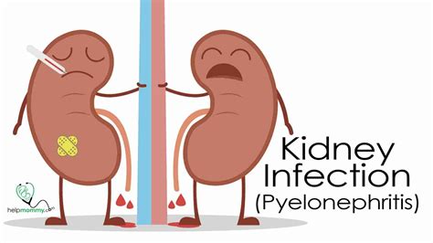 Kidney Infection (Pyelonephritis) - HelpMommy