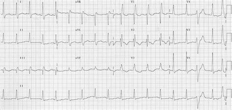 Preexcitation Syndromes Litfl Ecg Library Diagnosis