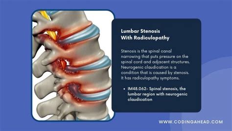 2022 How To Code Lumbar Radiculopathy Icd 10 List With Codes And Guidelines