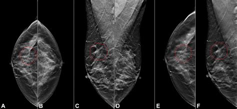 Artificial Intelligence For Reducing Workload In Breast Cancer