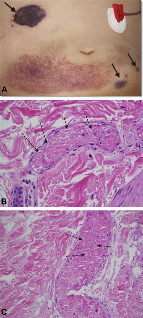 Diagnosis Of Deep Cutaneous Fungal Infections Correlation Between Skin