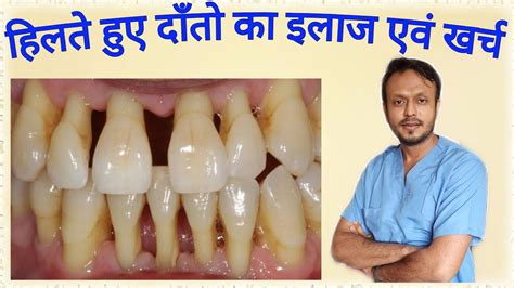 हिलते हुए दाँतो का क्या है इलाज एवं खर्च Tooth Mobility Treatment