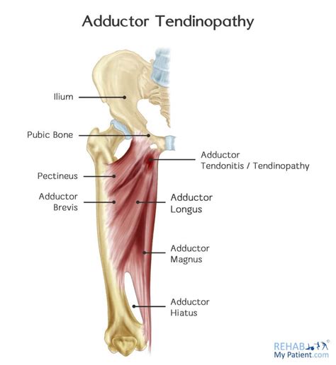 Adductor Tendinopathy Rehab My Patient