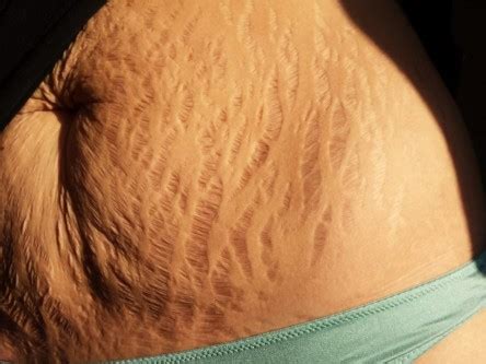 Ways To Get Rid Of Stretch Marks After Pregnancy Fast