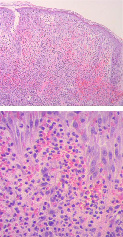 Estudio Histopatol Gico H E Y Epidermis Con Espongiosis