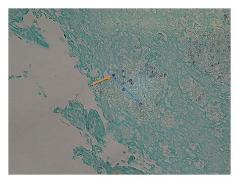 Splenic Biopsy On Grocott Gomori Methenamine Silver Gms Stain With Download Scientific