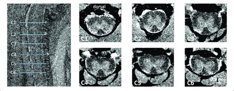 Ex Vivo Mri Of The Mouse Cervical Sc T Weighted Sagittal Spin