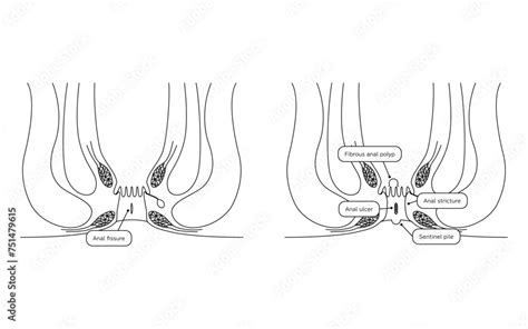 Diseases Of The Anus Hemorrhoids Anal Hemorrhoid Anal Ulcer Anal Stenosis Anal Polyp