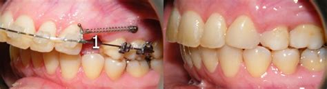 Before And After Pittsburgh Orthodontic Group