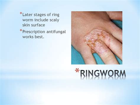 Ringworm Stages