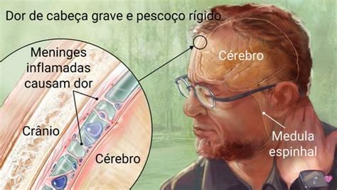 Meningite Causas Diagnóstico E Tratamento Enfermagem Florence