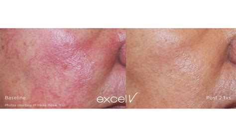 Best Treatment For Facial Redness Vujevich Dermatology Associates