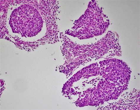 Squamous Cell Carcinoma Basaloid Variant Lung Bosnianpathology